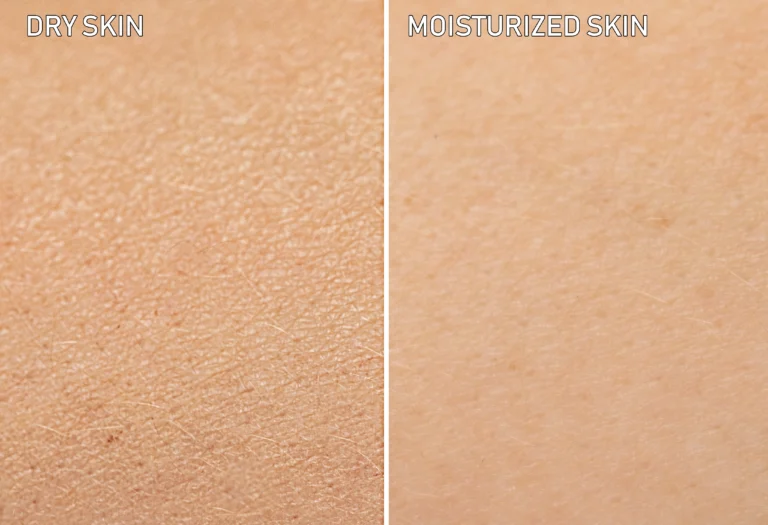 dry skin vs moisturised skin